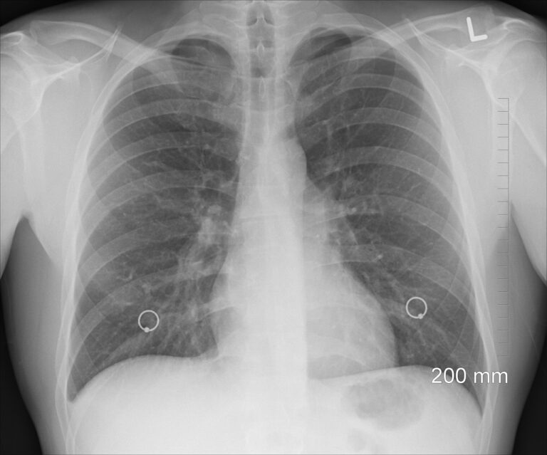 El Laboratorio Clínico ha desarrollado un algoritmo con marcadores tumorales que complementa el diagnóstico en cáncer de pulmón